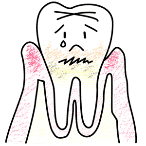 歯周病治療