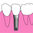 インプラント
